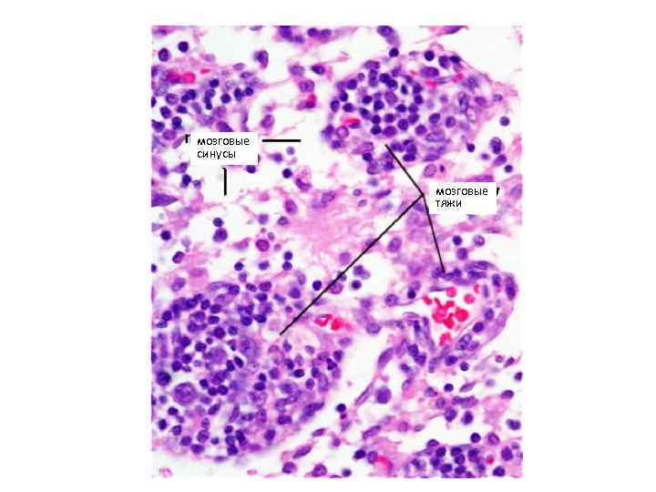 мозговые синусы мозговые тяжи 
