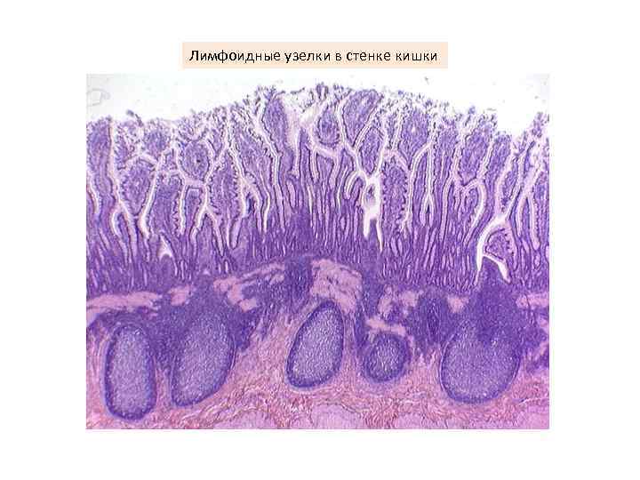 Лимфоидные узелки в стенке кишки 