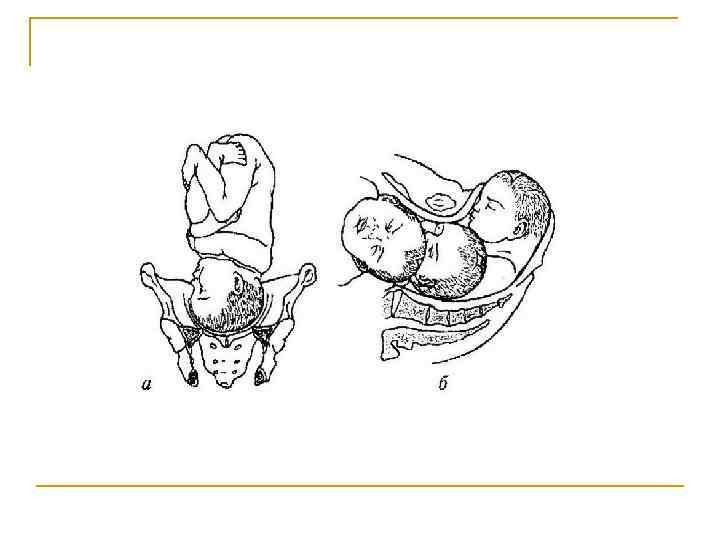 Запущенное положение плода. Расположение ребенка в тазовом предлежании. Головное предлежание плода. Ребенок в головном предлежании.
