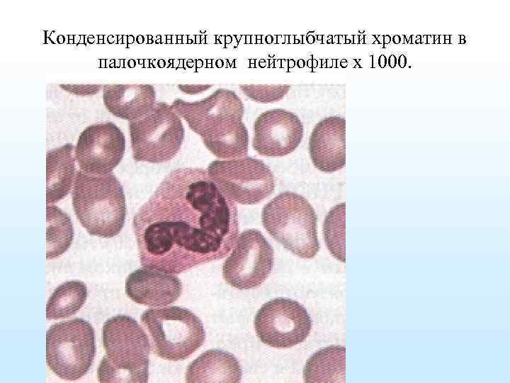 Конденсированный крупноглыбчатый хроматин в палочкоядерном нейтрофиле х 1000. 