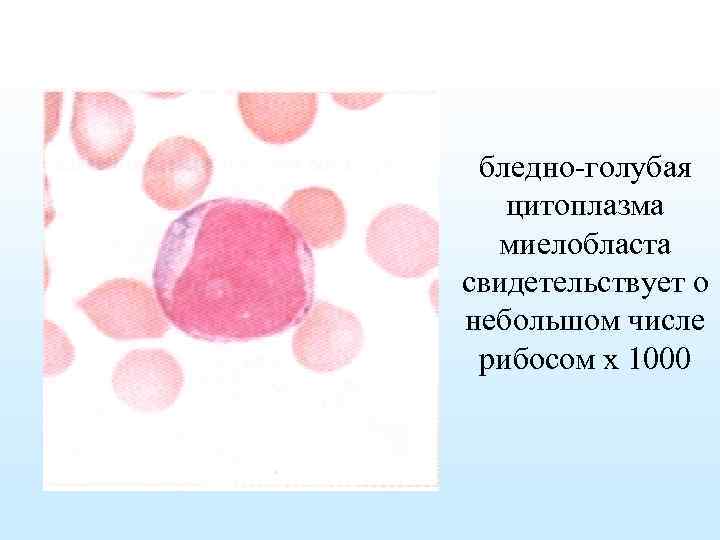 бледно-голубая цитоплазма миелобласта свидетельствует о небольшом числе рибосом х 1000 