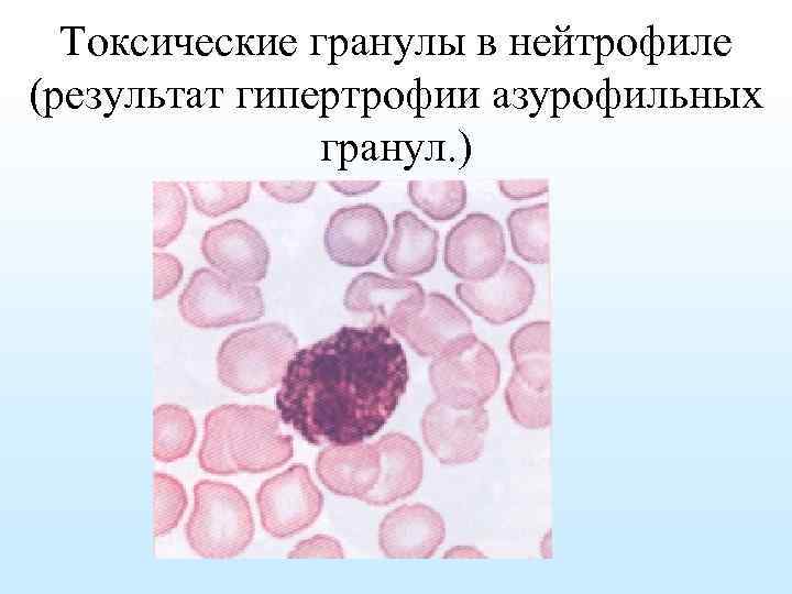 Токсогенная зернистость нейтрофилов. Азурофильные гранулы нейтрофилов. Токсигенная зернистость нейтрофилов. Азурофильные гранулы лейкоцитов.