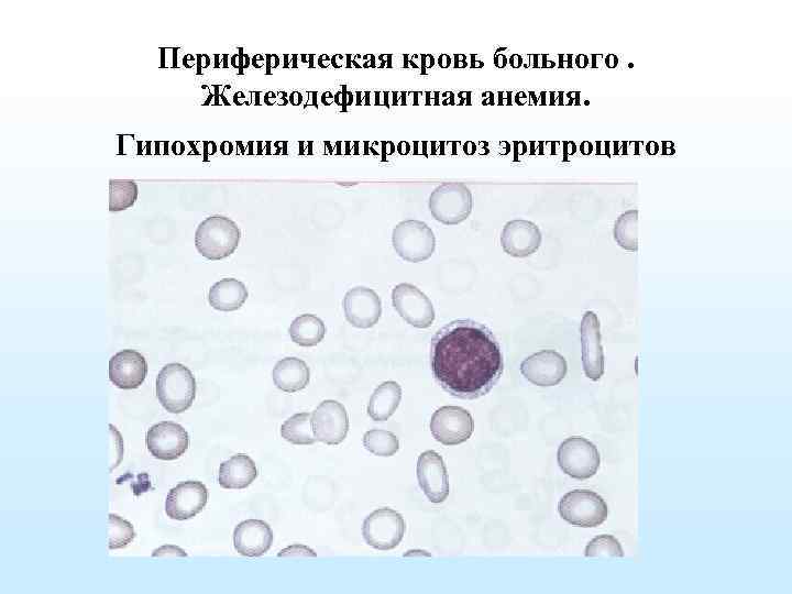 Периферическая кровь больного. Железодефицитная анемия. Гипохромия и микроцитоз эритроцитов 