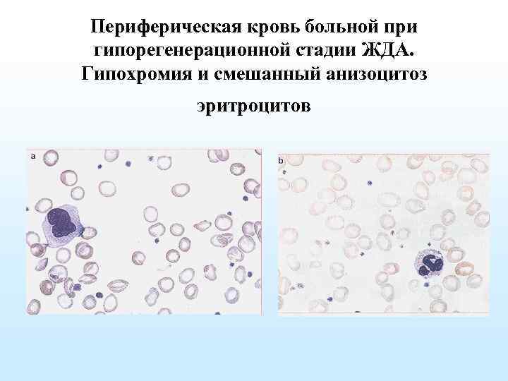 Периферическая кровь больной при гипорегенерационной стадии ЖДА. Гипохромия и смешанный анизоцитоз эритроцитов 