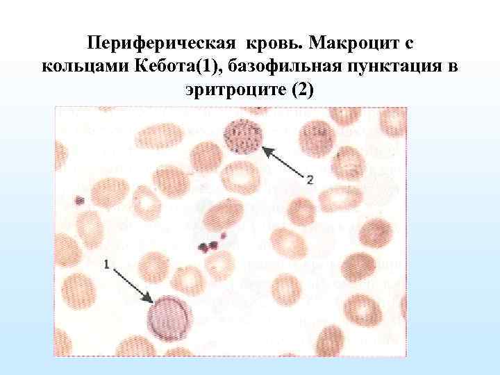 Базофильная пунктация эритроцитов фото