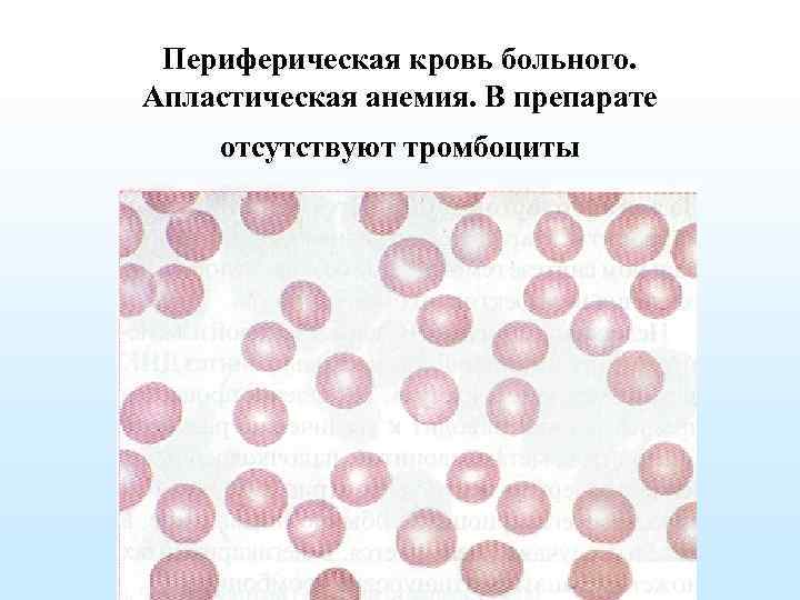 Картина крови при апластической анемии