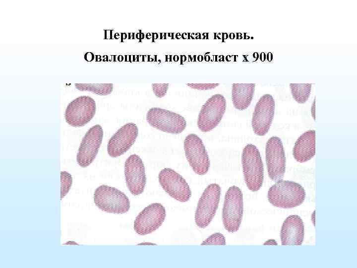 Эллиптоцитоз. Эллиптоциты (овалоциты). Наследственный эллиптоцитоз. Анемия нормобласты, овалоциты. Пойкилоцитоз овалоциты.