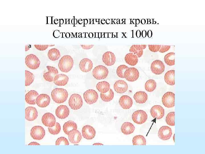 Периферическая кровь. Стоматоциты х 1000 