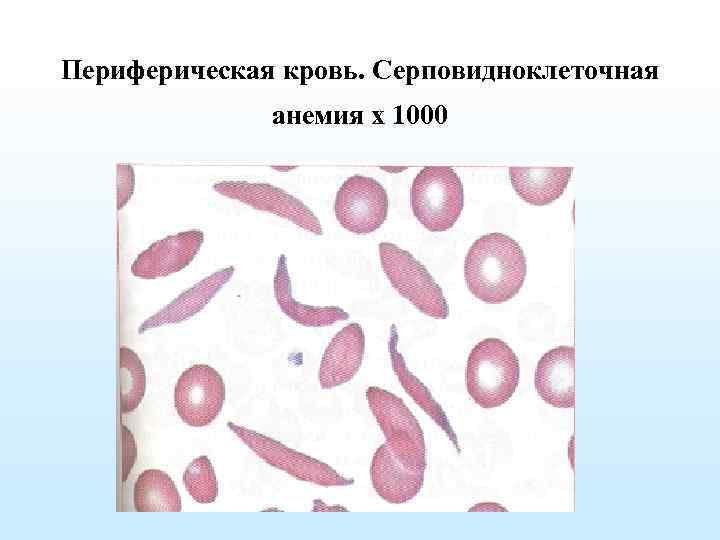 Периферическая кровь. Серповидноклеточная анемия х 1000 