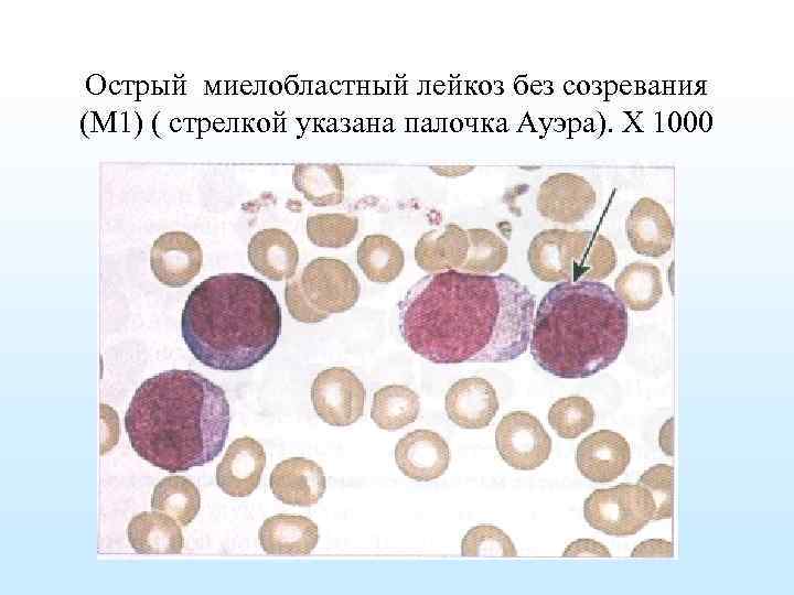 Миеломоноцитарный лейкоз картина крови