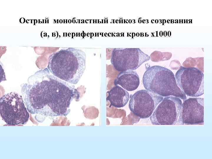 Миеломоноцитарный лейкоз картина крови