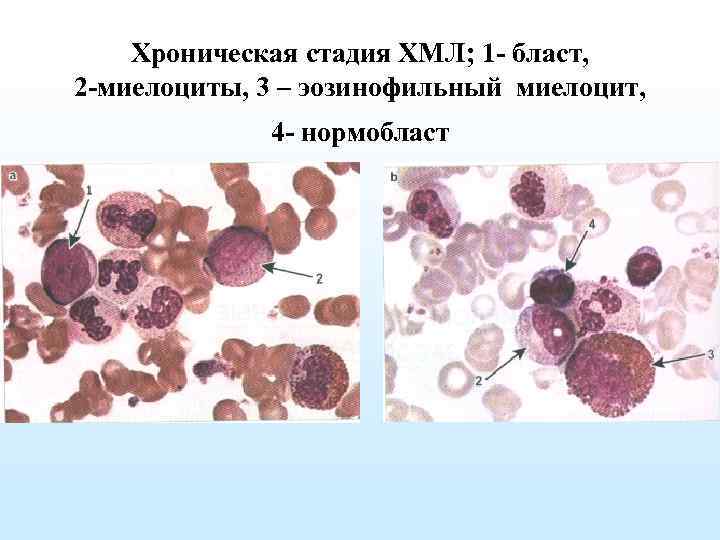 Хроническая стадия ХМЛ; 1 - бласт, 2 -миелоциты, 3 – эозинофильный миелоцит, 4 -
