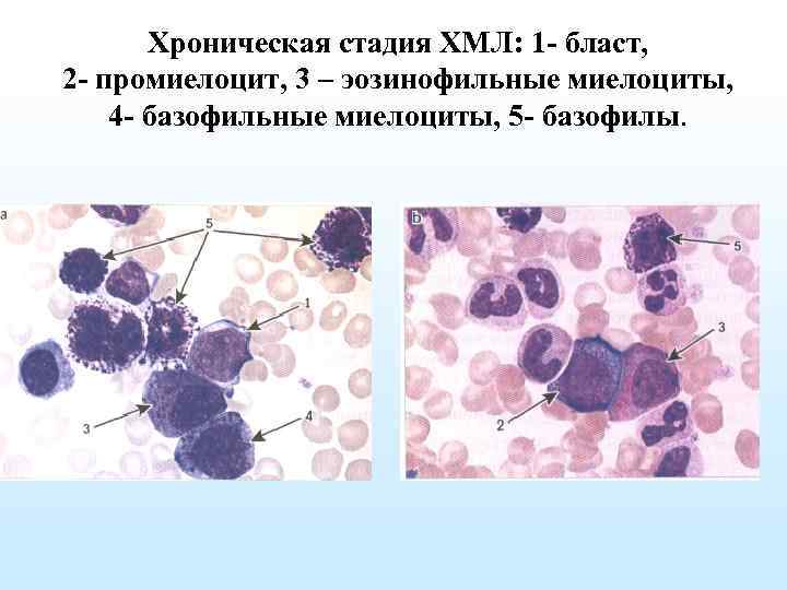 Хронический миелолейкоз презентация