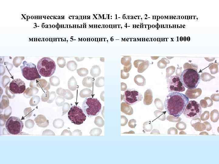 Хроническая стадия ХМЛ: 1 - бласт, 2 - промиелоцит, 3 - базофильный миелоцит, 4