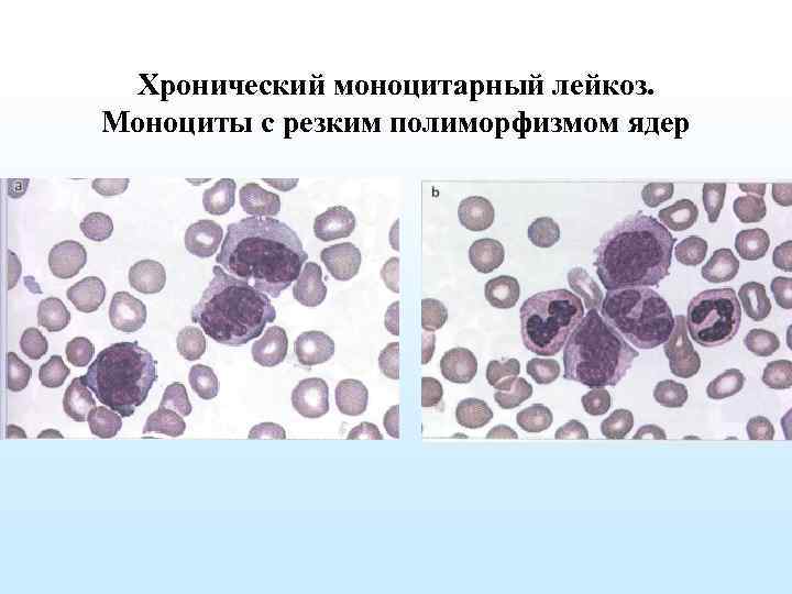 Хронический моноцитарный лейкоз. Хронический миеломоноцитарный лейкоз картина крови. Хронический миелобластный лейкоз гистология. Острый монобластный лейкоз. Картина крови. Острый миелобластный лейкоз патанатомия.