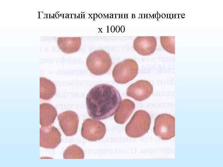 Глыбчатый хроматин в лимфоците х 1000 