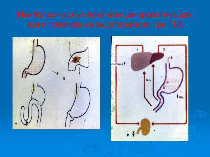 Наиболее частые локализации кровоточащих язв и проявления эндотоксикоза при ГДК 