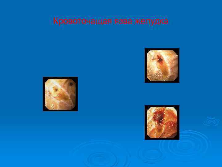 Кровоточащая язва желудка 