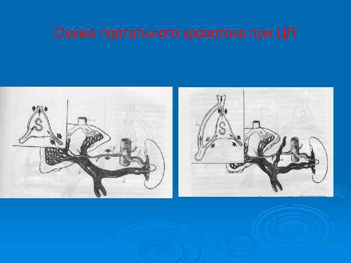 Схема портального кровотока при ЦП 