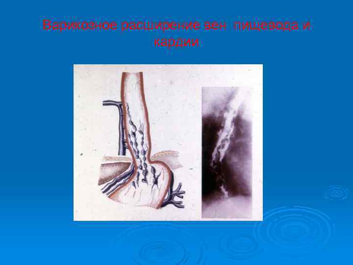 Варикозное расширение вен пищевода и кардии 