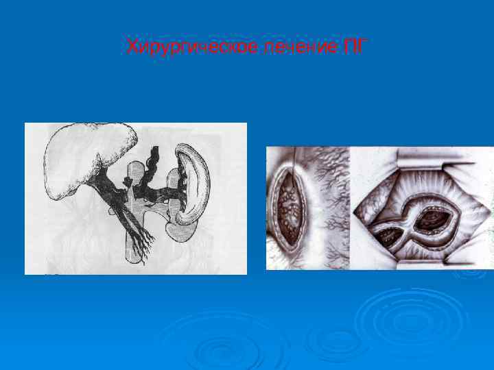 Хирургическое лечение ПГ 