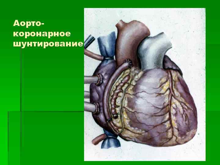 Аортокоронарное шунтирование 