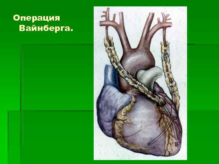 Операция Вайнберга. 