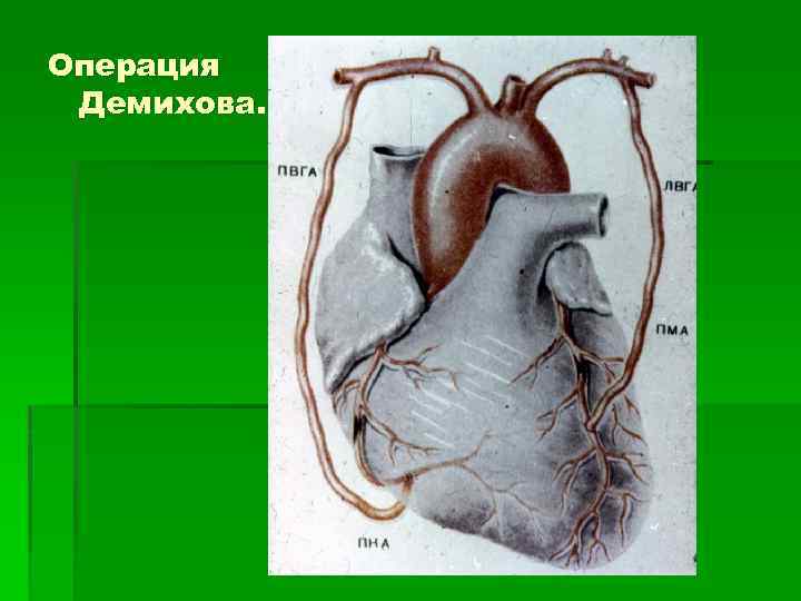 Операция Демихова. 