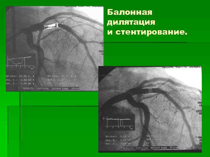 Балонная дилятация и стентирование. 