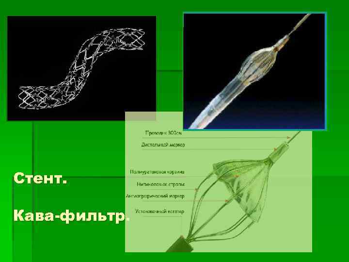 Стент. Кава-фильтр. 