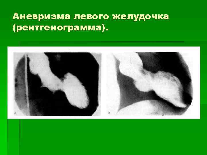 Аневризма левого желудочка (рентгенограмма). 