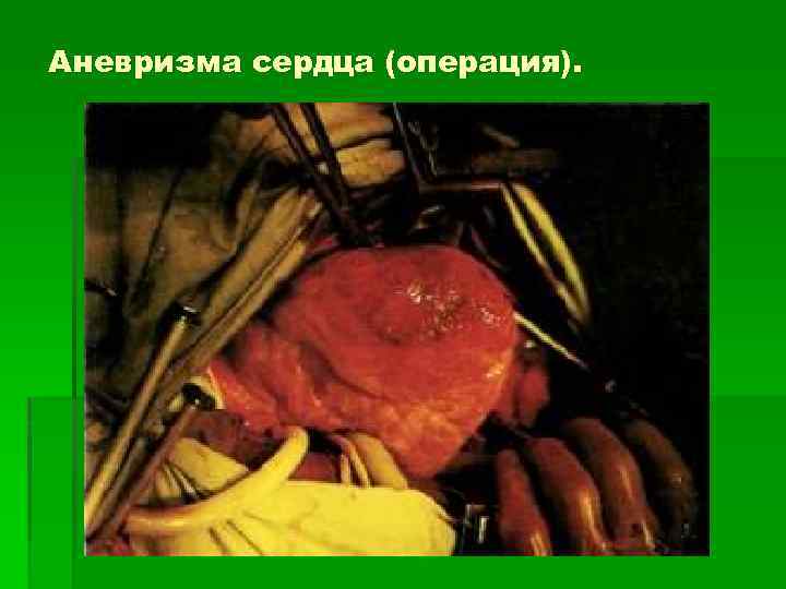 Аневризма сердца (операция). 