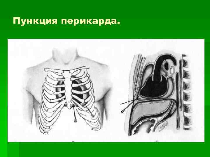 Пункция перикарда. 