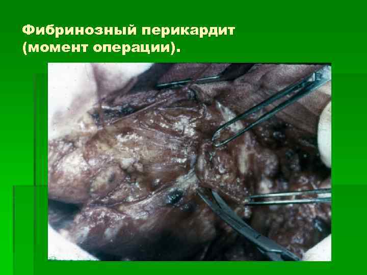 Фибринозный перикардит (момент операции). 
