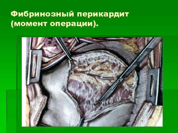 Фибринозный перикардит (момент операции). 