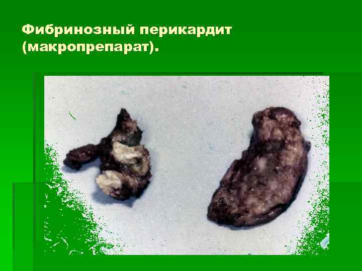 Фибринозный перикардит (макропрепарат). 