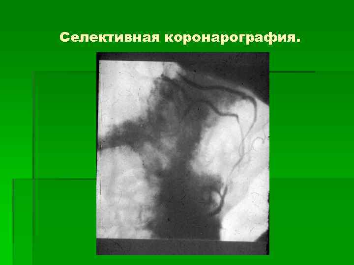 Селективная коронарография. 