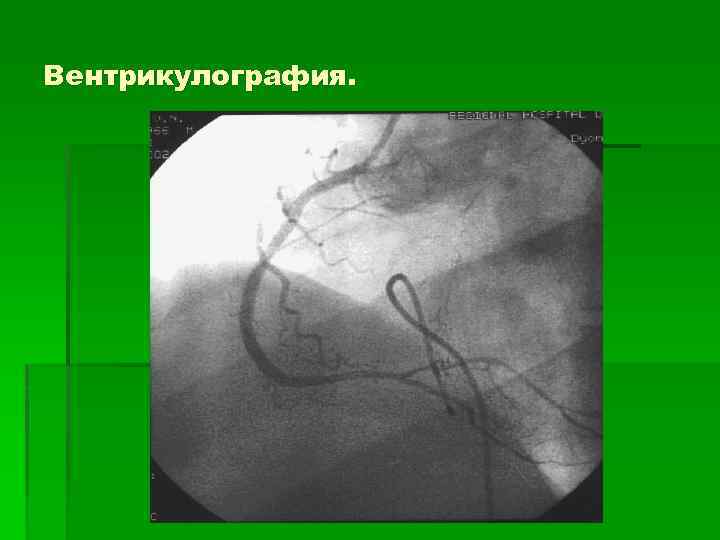 Вентрикулография. 
