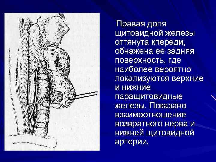 Правая доля щитовидной железы оттянута кпереди, обнажена ее задняя поверхность, где наиболее вероятно локализуются