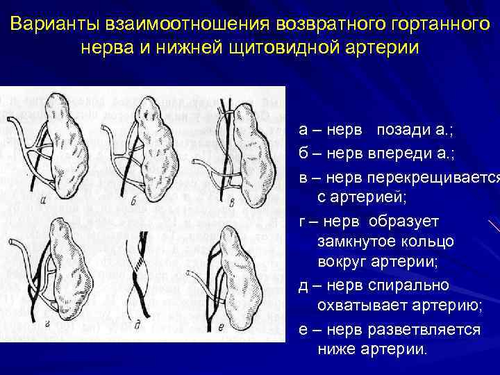 Варианты взаимоотношения возвратного гортанного нерва и нижней щитовидной артерии а – нерв позади а.