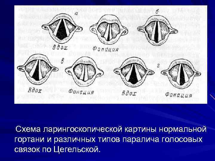 Схема ларингоскопической картины нормальной гортани и различных типов паралича голосовых связок по Цегельской. 