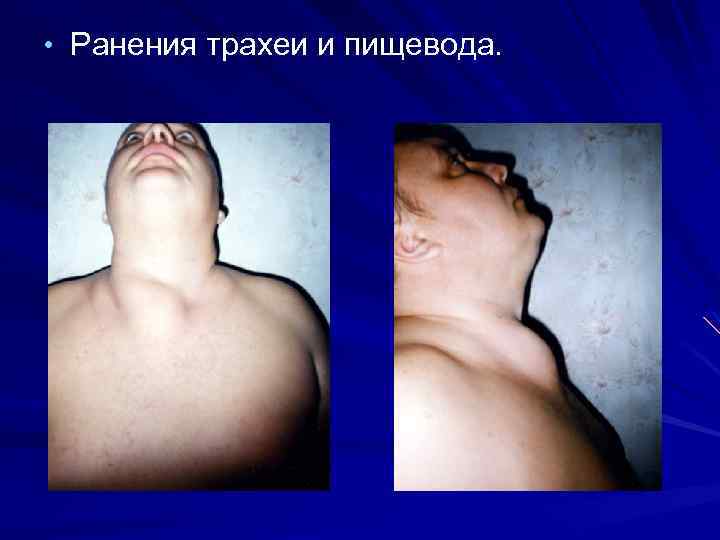  • Ранения трахеи и пищевода. 