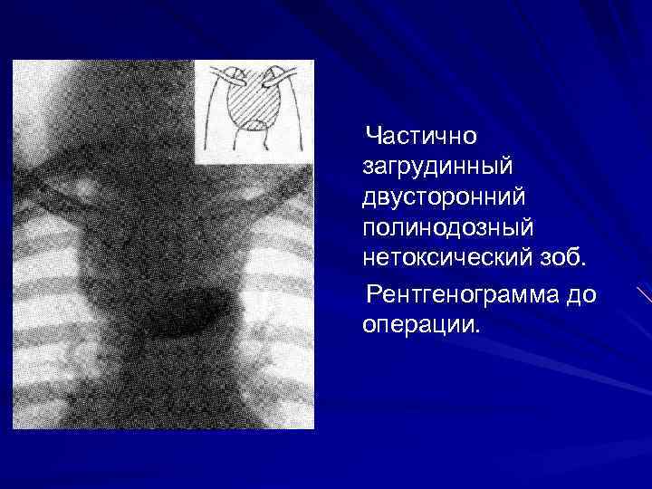 Частично загрудинный двусторонний полинодозный нетоксический зоб. Рентгенограмма до операции. 