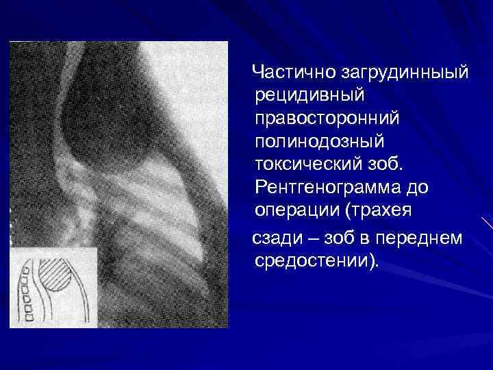 Частично загрудинныый рецидивный правосторонний полинодозный токсический зоб. Рентгенограмма до операции (трахея сзади – зоб