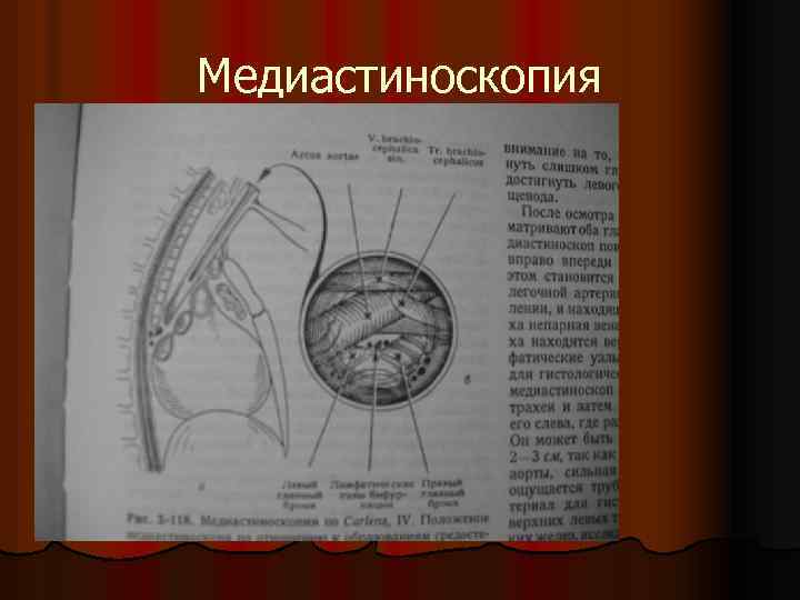 Медиастиноскопия 
