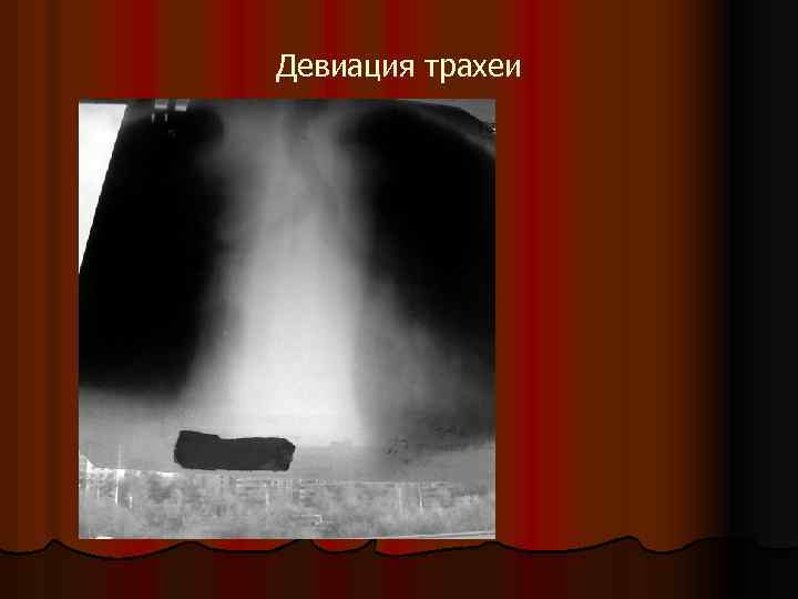 Девиация трахеи 