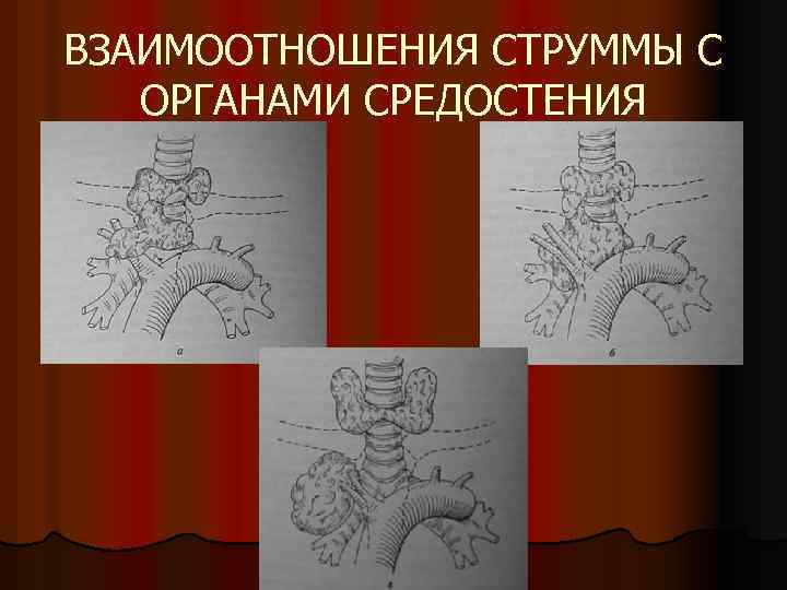 ВЗАИМООТНОШЕНИЯ СТРУММЫ С ОРГАНАМИ СРЕДОСТЕНИЯ 