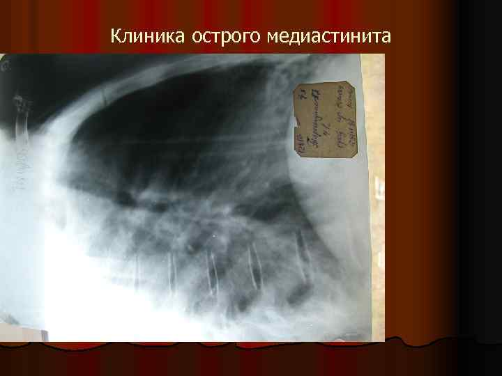 Клиника острого медиастинита 