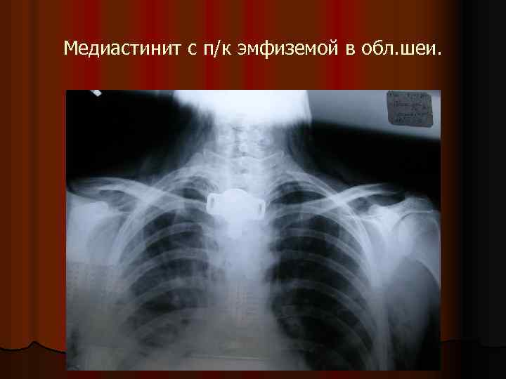 Медиастинит с п/к эмфиземой в обл. шеи. 