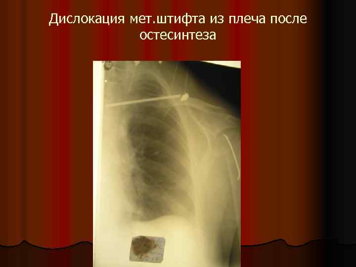 Дислокация мет. штифта из плеча после остесинтеза 